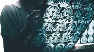 Untangling Alzheimer’s disease Untangling Alzheimer’s disease